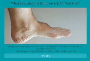 Success Story: No More Bump on Top of the Foot