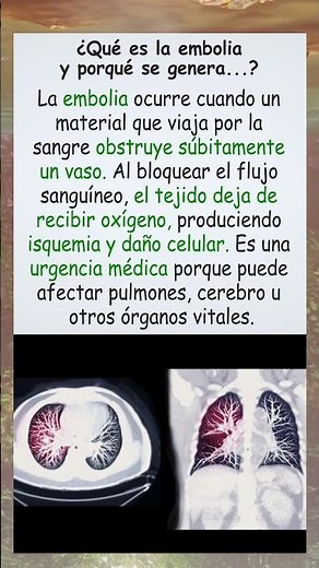 ¿Qué es una embolia?