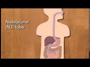 Why are there different types of feeding tubes?