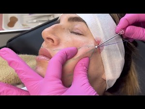 Amazing Results with Lifting Threads on a Younger Patient