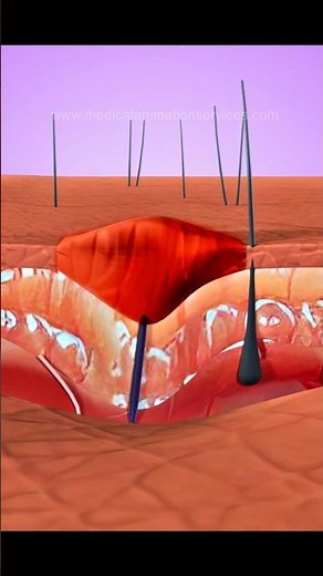 How to remove stuck thorn? | फंसे हुए कांटे को कैसे निकालें? #asmr #facts #medicalanimation #science
