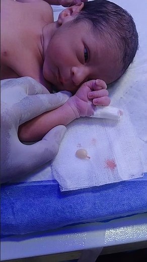 “From Extra Finger to Normal Hand | Polydactyl Baby Surgery”