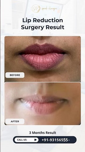 Lip Reduction Before & After | 3 Month Result 🔥
