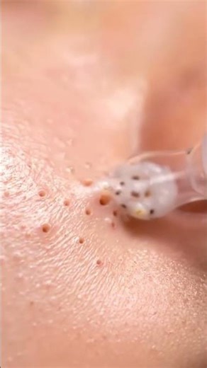 Tiny Pores, Big Blackheads — Deep Clean
