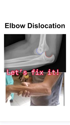 Elbow Dislocation? Are you ready to fix the problem? #emergencymedicine #理学療法