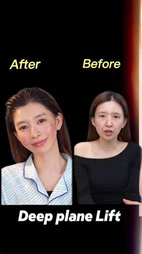 Embrace Youthful Appearance with Facelift Techniques