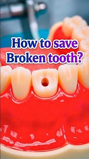 Fixing a Broken Tooth with a Post, Core Build-Up & Crown #dentist #satisfying