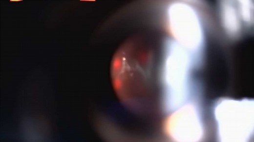 【玻璃体浑浊】飞蚊症怎么治？艾格眼科彭志华主任为患者实施玻璃体激光消融术，精准消灭“飞蚊”