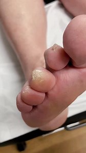 293K views · 815 reactions | Discover how an Aussie podiatrist tackles toe callus and corn removal! 禮 #FootCare. . . . #footpain #plantarfasciitis #heelpain #podiatry #footcare #podiatrist #orthotics #feet #foothealth #kneepain #foot #running #anklepain #backpain #bunions #flatfeet #healthyfeet #footpainrelief #arthritis #health #footdoctor #bunion #fyp #foryou #viralreels #exploremore | Docpods Treatment | Facebook