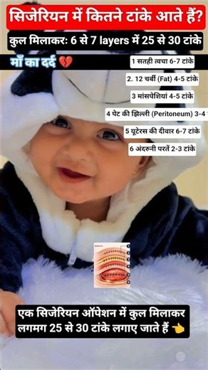 25 to 30 stitches are used in a cesarean operation. Pregnancy Short #shortsfeed #virals #shorts