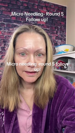 Micro Needling Round 5 Follow Up: Glowing Results!