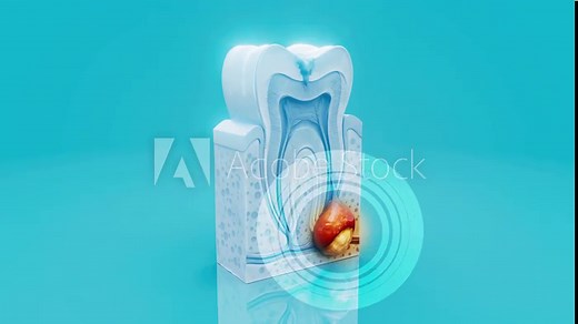 Conceptual 3D animation of a dental abscess with pus and infection