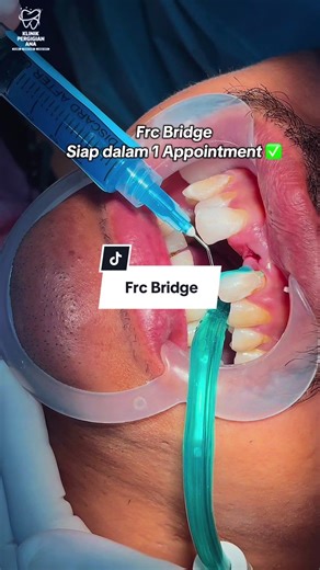 Ganti Gigi Hilang dengan Rawatan Frc Bridge