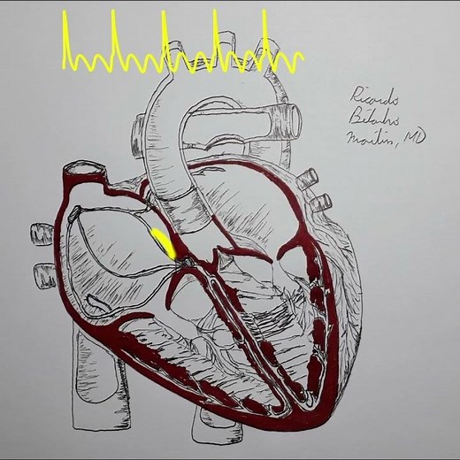 Flutter auriculaire - Animation cardiaque et ECG