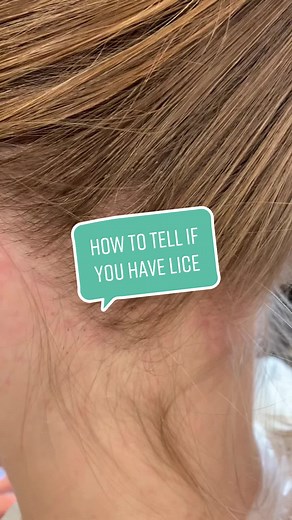 Lice isnt always easy to spot. Here’s what to look for. #lice #liceremoval #licecenterswi #licetok #fyp