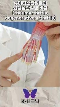류마티스관절염과 퇴행성관절염 비교 rheumarthritis, degenerative arthritis
