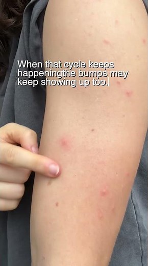 Why Does Folliculitis Keep Coming Back?