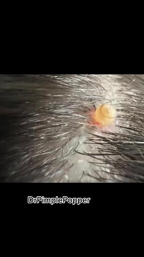 #stitch with @jillblevins18 I haven’t examined you myself but maybe this is what you have? #drpimplepopper #SLMDskincare #botfly #dermatologist PLEASE see your physician if you are having any issues with your scalp. Thank you for reaching out to me!