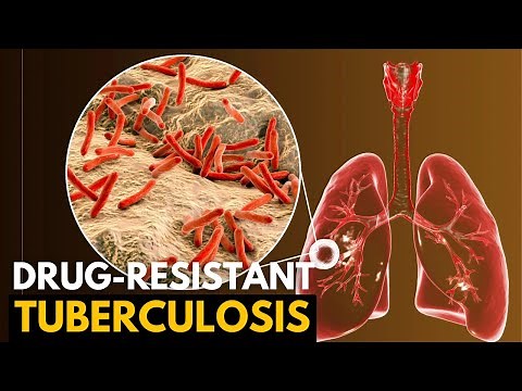 Tuberculosis, Causes, Signs and Symptoms, Diagnosis and Treatment.