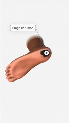 Acral Lentiginous Melanoma Explained #alma #melanoma #skincancerawareness #healthtips #3danimation