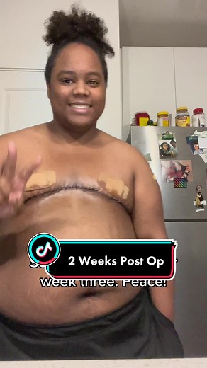 Two weeks post op #topsurgery #topsurgeryrecovery #trans #ftm #nonbinary #queer #lgbtq #transmasc #blacktransmasc #gay #plasticsurgery #drgallagher #enby #transgender
