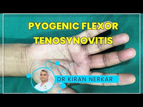 Pyogenic Flexor Tenosynovitis