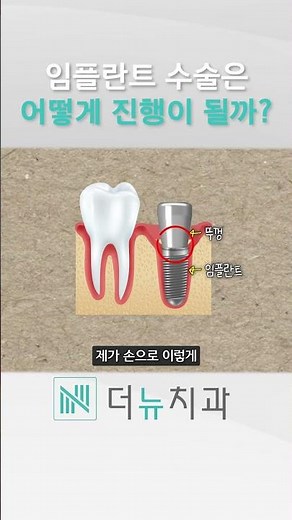1분 임플란트 수술 과정