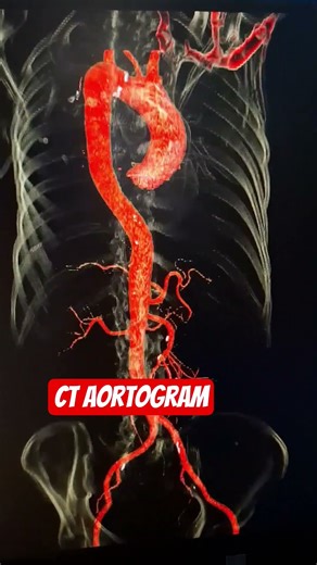 CT Aortogram #anatomy #viral #shorts #ytshoppingxnykaa