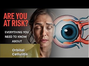 Orbital Cellulitis Explained Causes, Symptoms and Treatment, All Insights