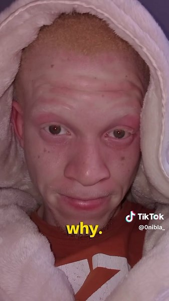 It only takes a little bit of white brainwash....😭😭#explore #albino#blackpower