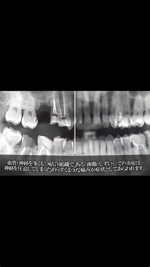 虫歯が進行するとどうなる？夜に歯が痛む理由