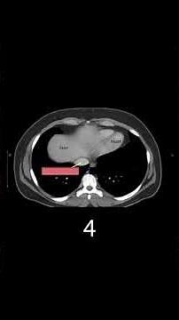 CT Anatomy for Beginners (Part 5)