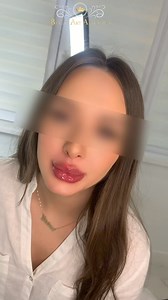 Lips În perioada 24-26 iunie 1 ml doar 199€ redus de la 310€ Programări:0722.296.007 | Clinica Beauty Art Aesthetics | Facebook