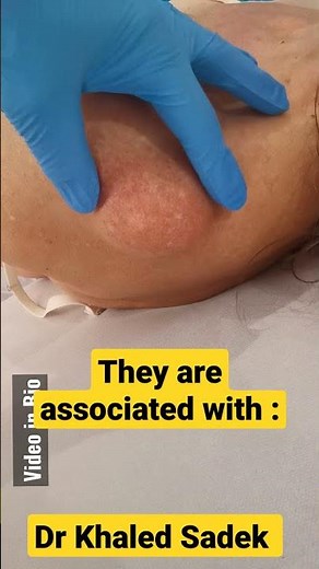 Large Lipoma #cystremoval Dr Khaled Sadek