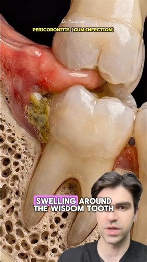 Wisdom Tooth Caused This MASSIVE Bump