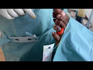 Corn Removal Surgery on Top of Toes of Feet