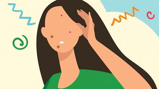 How Do Pimple Patches Work?