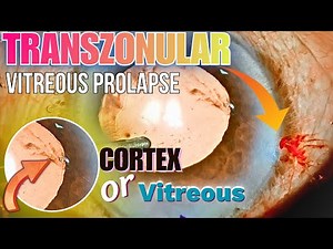 Intra-operative surprise, Transzonular vitreous prolapse: Dr. Deepak Megur
