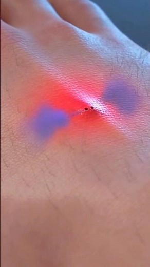 How to treat a spider bite 😲