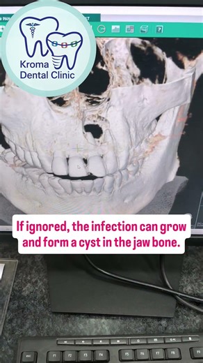 See a small pimple on your gum?Your body might be draining an infection from the tooth