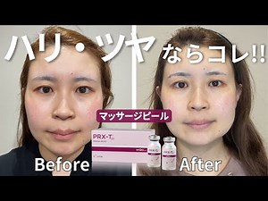 【美容初心者にもお勧めの施術！】マッサージピール施術風景 作用、治療経過、施術の流れをご紹介致します✨