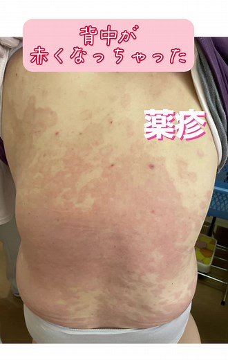 薬疹による背中のかゆみと対処法