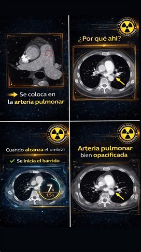 Radiologia on Instagram: "📌 ROI EN ANGIO-TC PARA TEP En el estudio de tromboembolismo pulmonar (TEP), la correcta colocación del ROI (bolo tracking) en la arteria pulmonar es clave para lograr el momento exacto de adquisición. 👉 Un ROI bien ubicado permite: ✔️ Óptima opacificación con contraste yodado ✔️ Mejor visualización de defectos de relleno ✔️ Estudios diagnósticos de calidad ✔️ Evitar repeticiones innecesarias 🎯 ROI correcto = diagnóstico confiable Si trabajás en tomografía, este detal