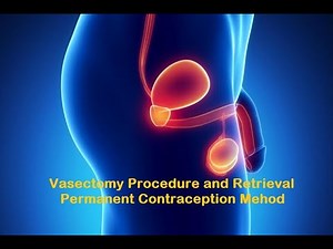 Vasectomy Procedure and Retrieval