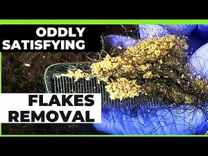 Oddly Satisfying, Insane, Extreme and Unbelievable Dandruff Flakes Removal After Braids! Wowww!