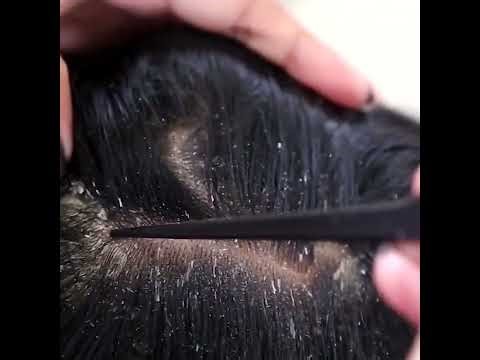 The Huge Dandruff Combing you Never Seen Before 7