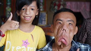 5.2M views · 10K reactions | Anh Mến dị dạng và cô bé mặt khỉ gặp...