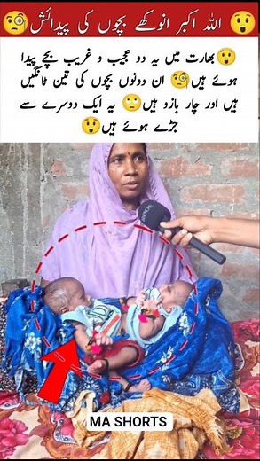 Strange Birth in India | Conjoined Twins with Three Legs #hearttouching #emotionalstory