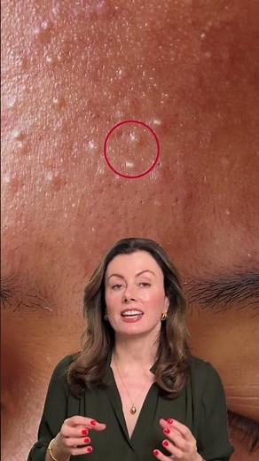 Closed Comedones OR Whiteheads 🤔 Dr Sam explains the difference and why it matters! #acne