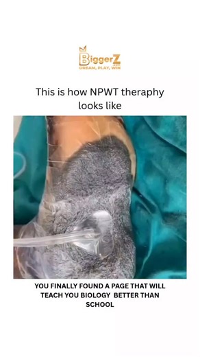 BIOLOGY | HEALTH | MEDICAL on Instagram: "NPWT (Negative Pressure Wound Therapy) is a medical treatment that promotes wound healing by applying a vacuum dressing to enhance blood flow, reduce fluid, and promote granulation tissue growth. It’s often used for chronic or complex wounds, such as diabetic foot ulcers, pressure sores, or post-surgical wounds. Dm for credit or removal👏🏻 For educational purposes only...... @biggerz #viralreels #insane #bio #BiomedicalScience #biology #BiologyNerd #bio